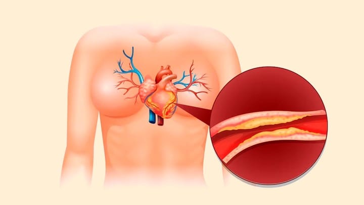 Jangan Abaikan! Tanda Arteri Tersumbat yang Muncul di Malam Hari