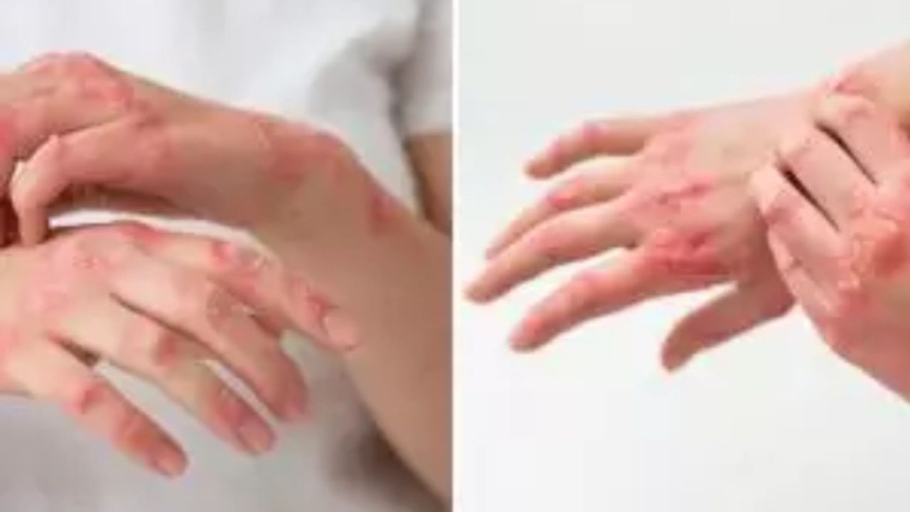 Mengenal Scabies: Gejala, Penyebab, dan Pengobatan yang Efektif