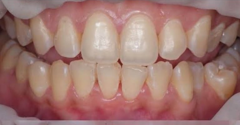 5 Dampak Buruk Kesehatan Gigi yang Perlu Diketahui