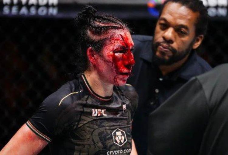 Irene Aldana Alami Luka Parah, Kalah dari Norma Dumont di Noche UFC