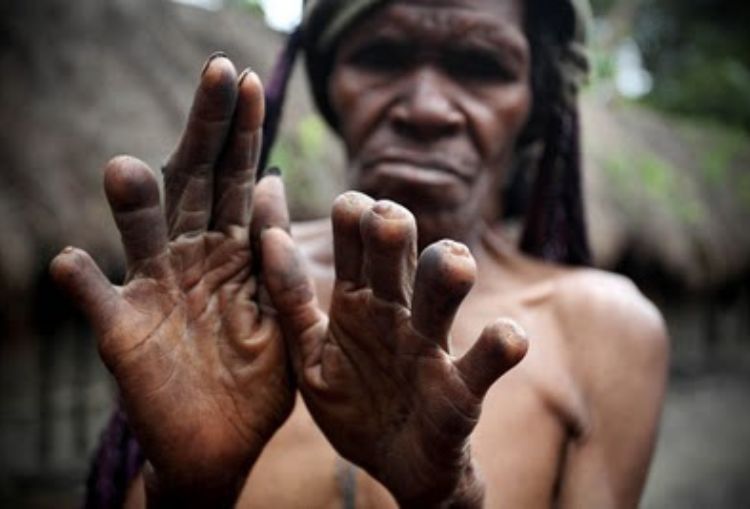 Tradisi Potong Jari, Ekspresi Kesedihan Ekstrem di Pegunungan Tengah Papua