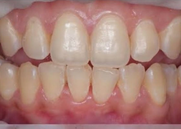 5 Dampak Buruk Kesehatan Gigi yang Perlu Diketahui