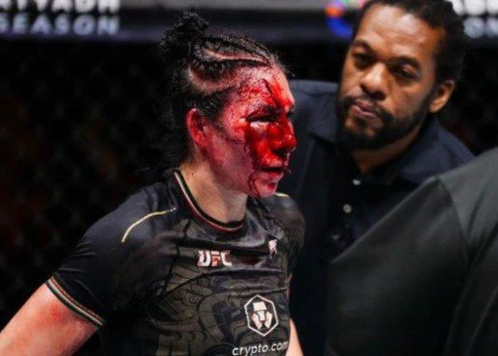 Irene Aldana Alami Luka Parah, Kalah dari Norma Dumont di Noche UFC